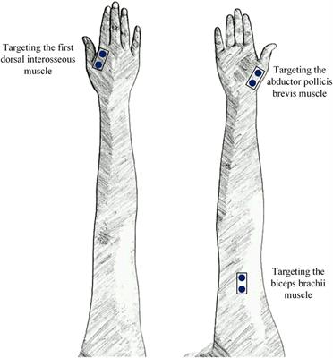 Surface Electromyographic Examination of Poststroke Neuromuscular Changes in Proximal and Distal Muscles Using Clustering Index Analysis